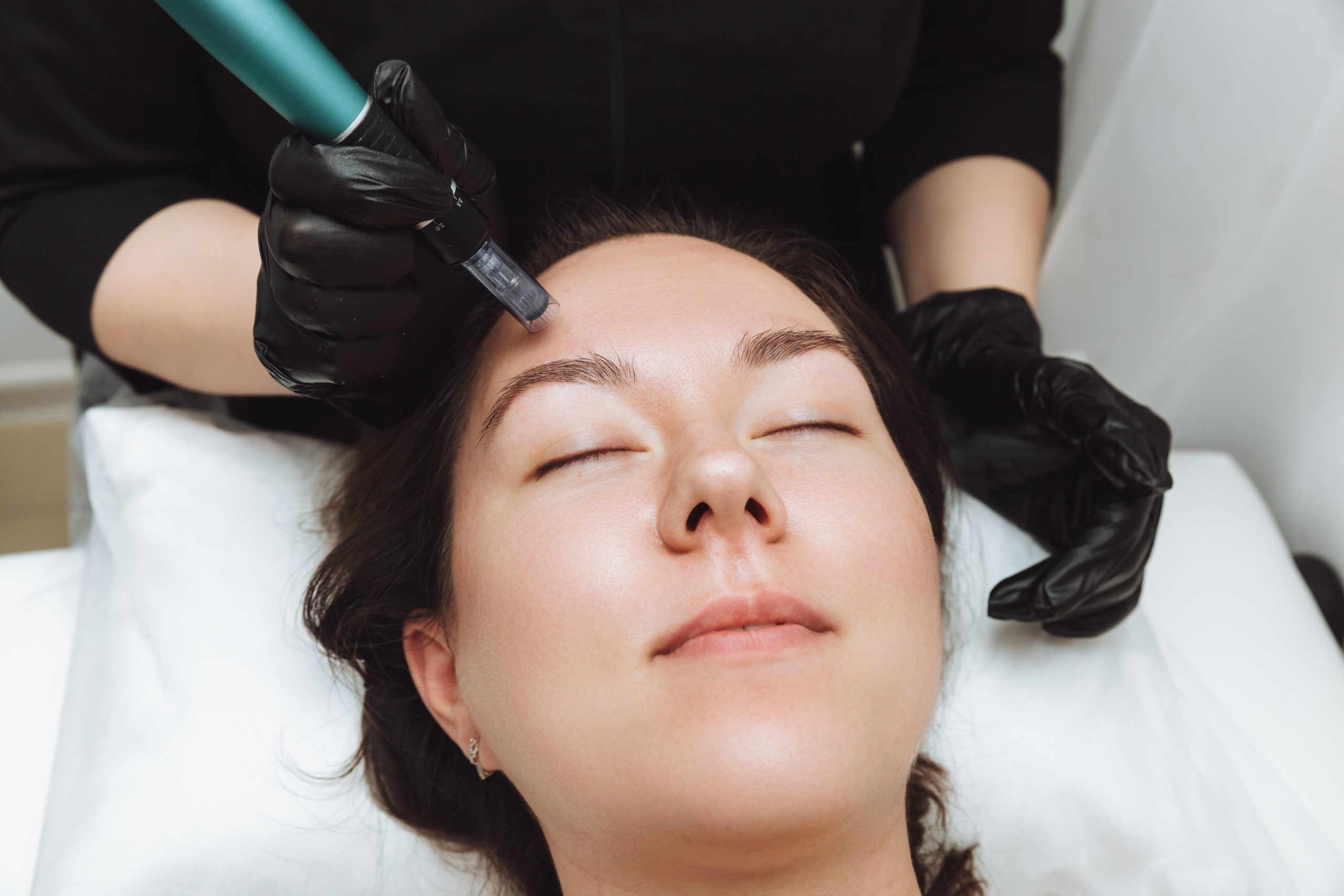 Learn More About Microneedling